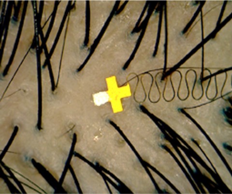 A micro-scale brain sensor placed between hair follicles. A micro-scale brain sensor placed between hair follicles.
